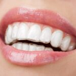 Transparent aligners